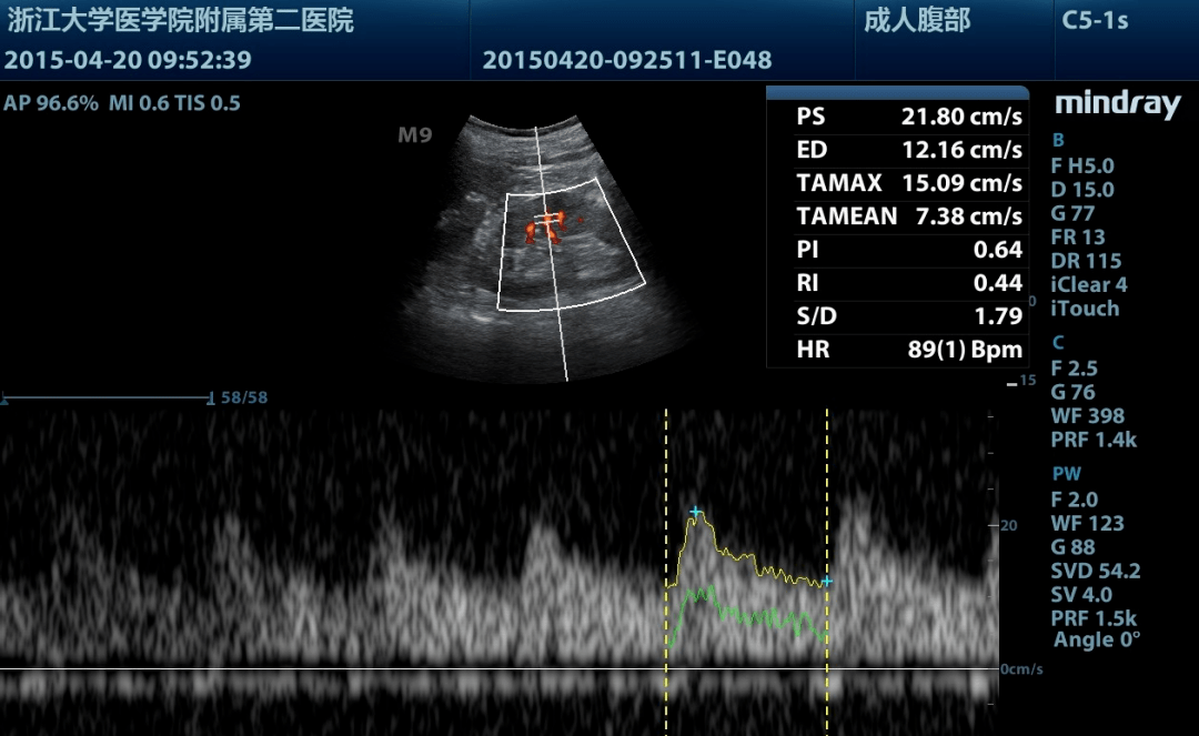 零基础入门「肾脏超声」,掌握切面与测量就够了!