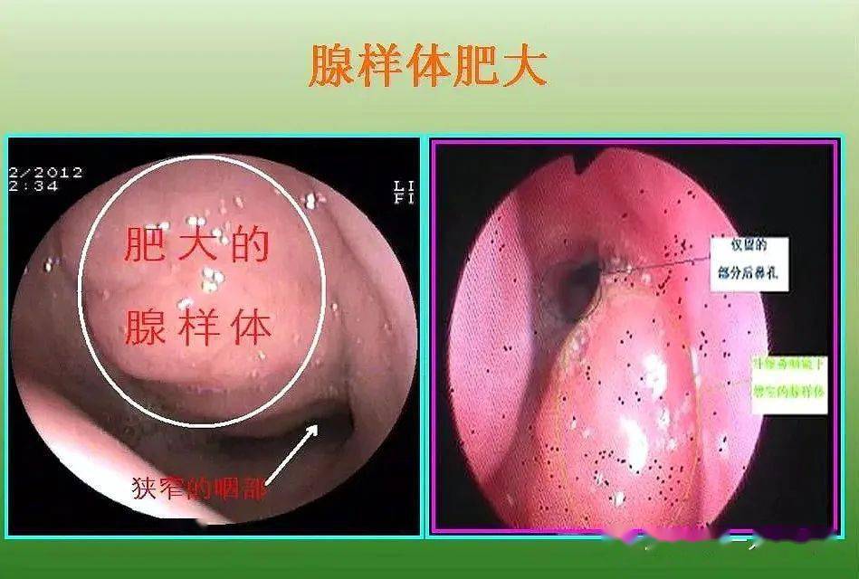 【健康宣教】孩子打呼噜声音特别大,小心是腺样体,扁桃体肥大!