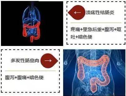 大便带血,这种颜色需谨慎,当心是癌!