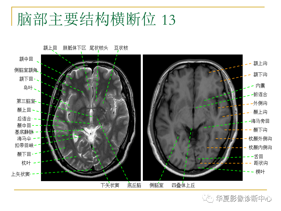 脑mri必备丨最详细的脑mri解剖