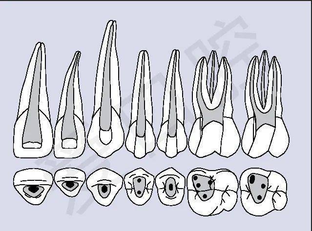 上颌牙齿开髓洞型图
