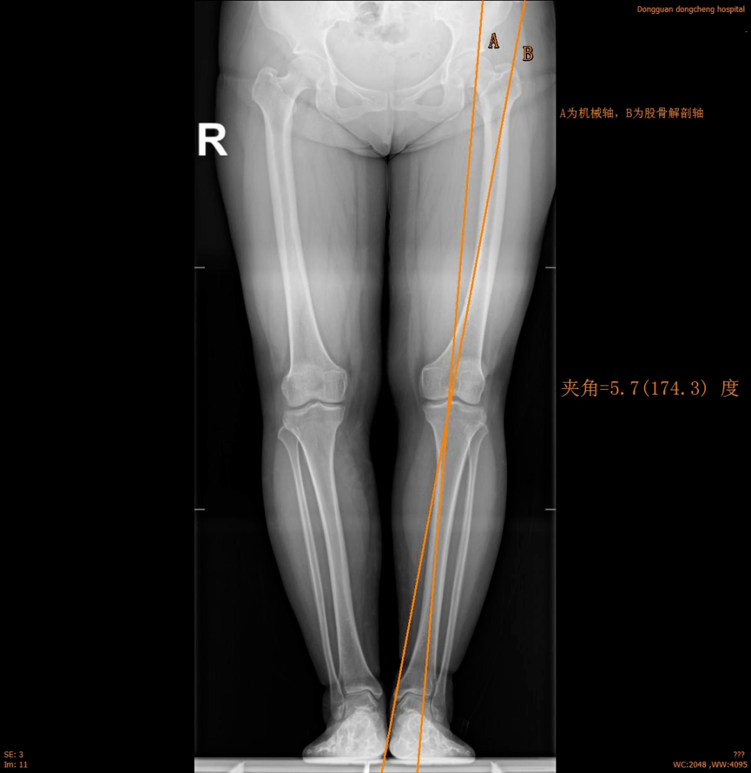 准确地反映长骨的整体情况,精确地测量下肢机械轴与股骨解剖轴的夹角