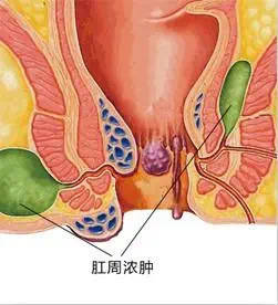 肛肠疾病不尴尬 及时就医别拖延_肛门