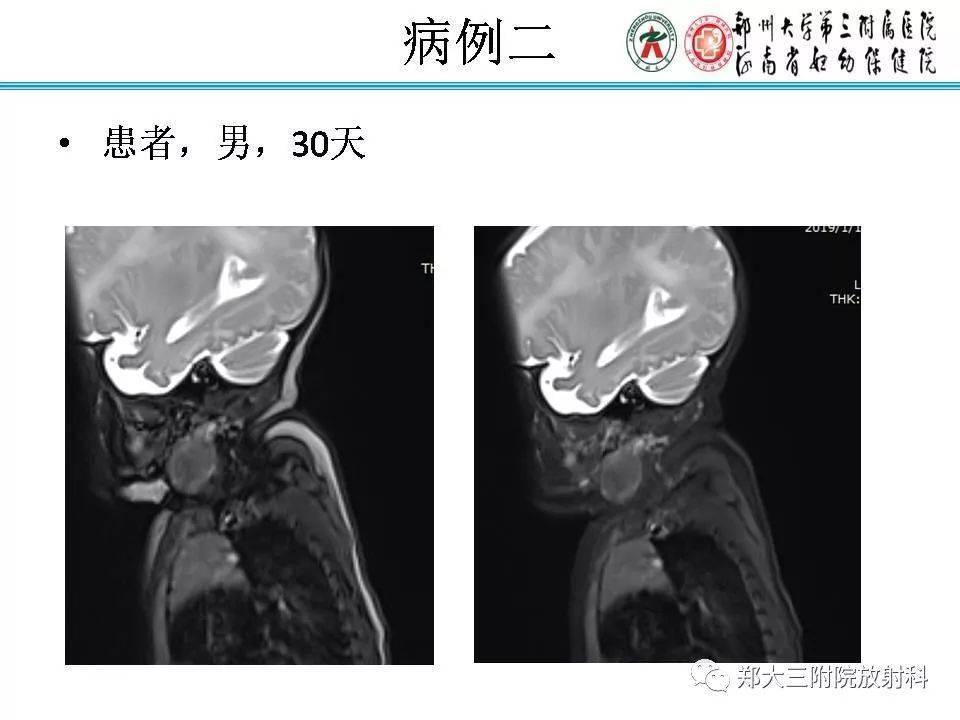 结节性筋膜炎影像表现