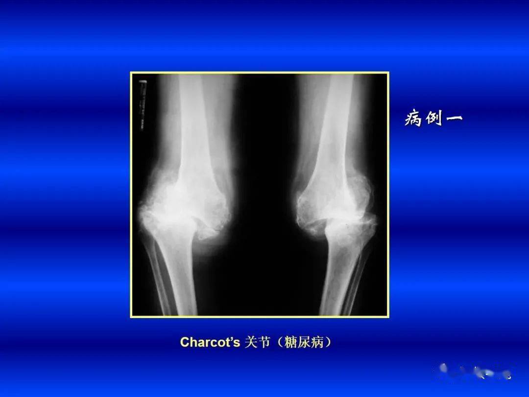 超全!各种关节炎的影像学表现