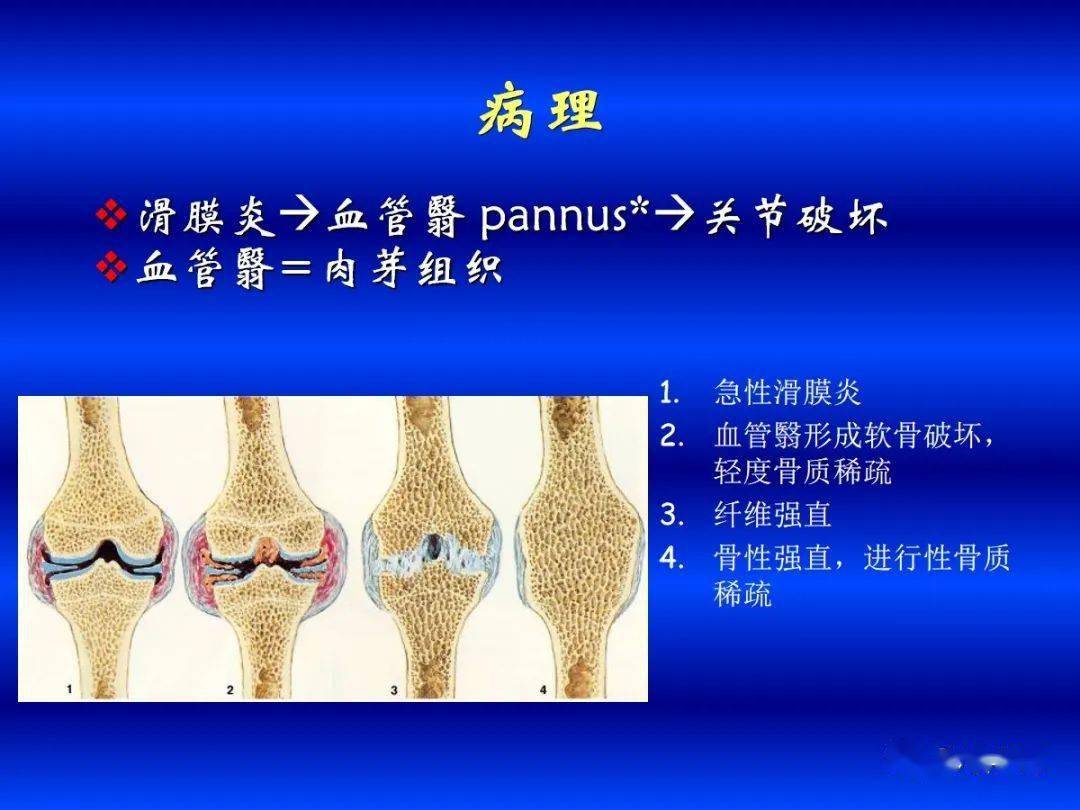 超全!各种关节炎的影像学表现