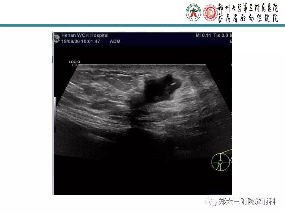 结节性筋膜炎影像表现