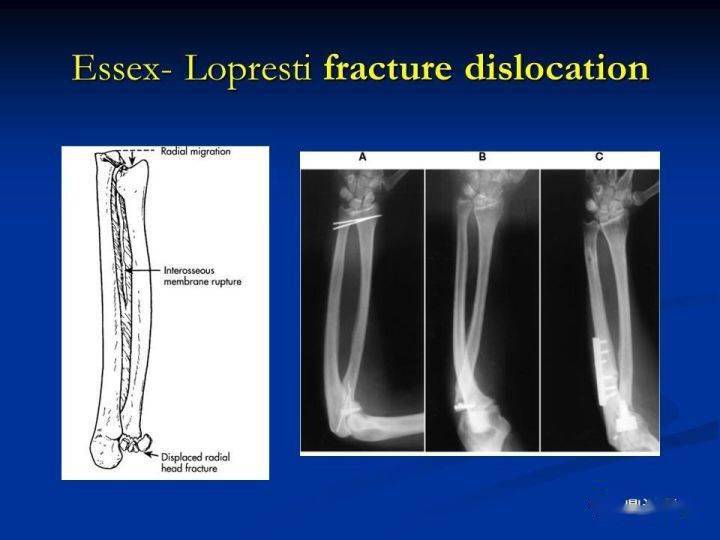 十,galeazzi骨折:桡骨干下1/3骨折合并尺骨小头脱位.