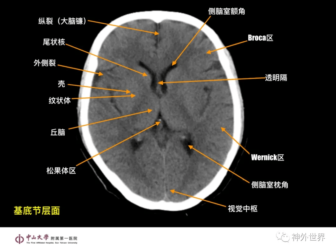 急诊头颅ct-"3b"阅片法,这个阅片法值得推荐