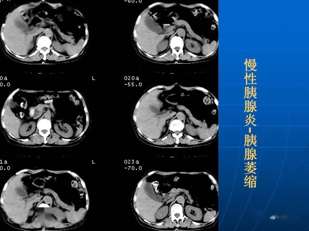 9种胰腺常见疾病的ct诊断