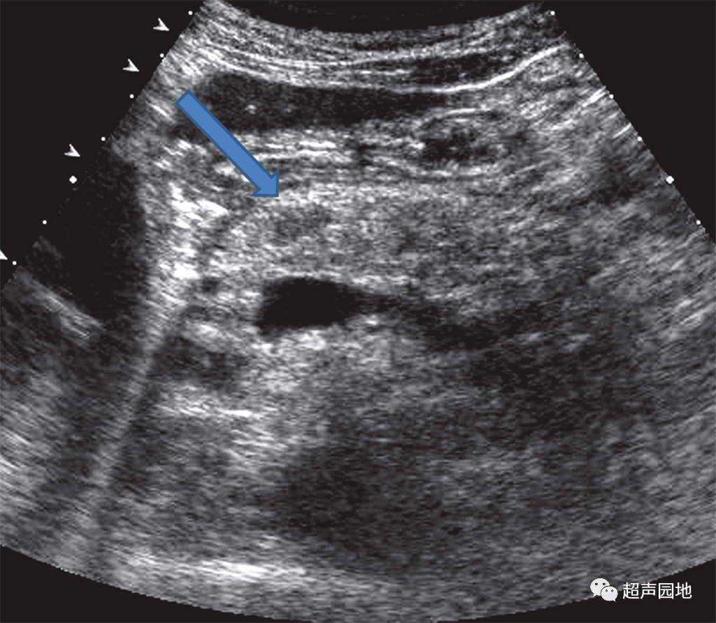 蓝色箭头所示为急性胰腺炎不均匀实质内的局灶性低回声区.