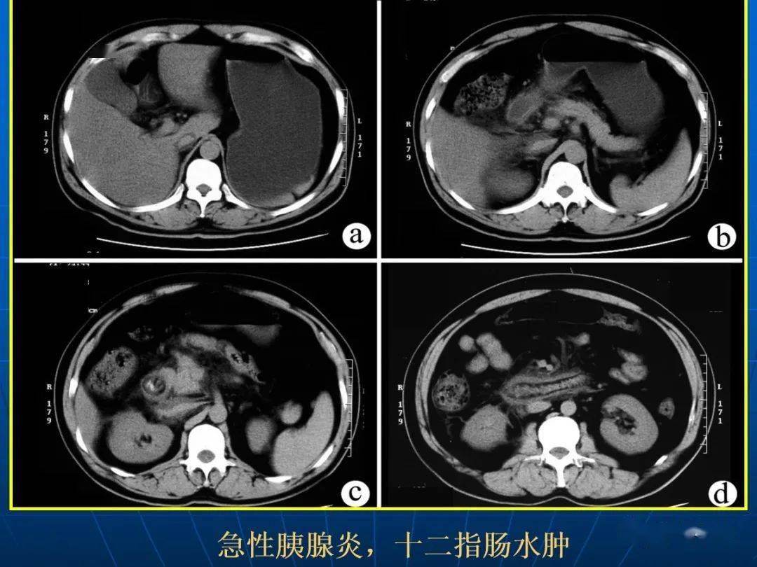 9种胰腺常见疾病的ct诊断