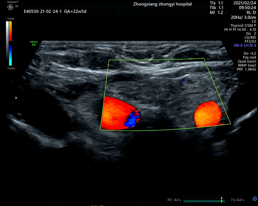 多发线状及点状高回声图 3 患儿一:甲状腺左侧叶稍低回声团内血流图 2