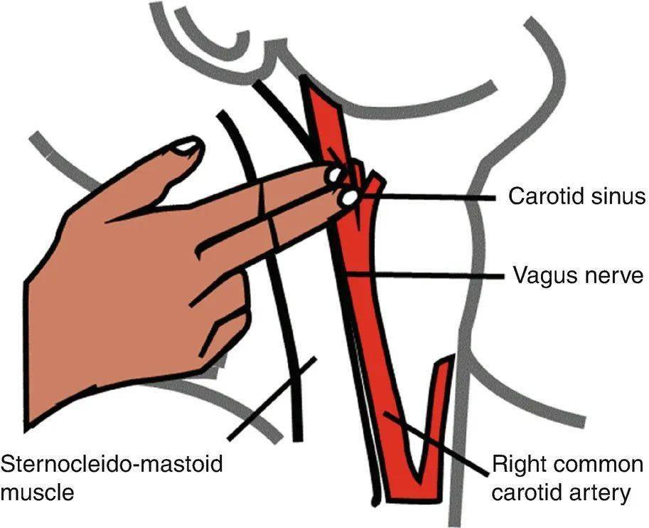 颈动脉窦( carotid sinus)| 图源:kasperowicz a. et al., (2020)