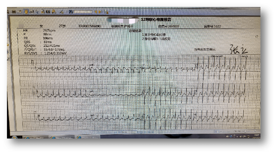 室上性心动过速,hr 237bpm急查心电图示:3.