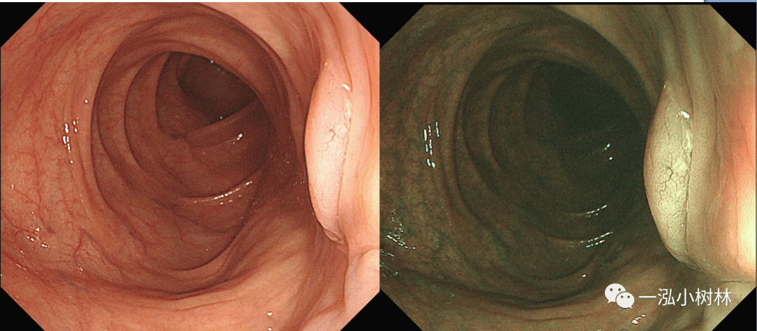 结肠息肉图谱