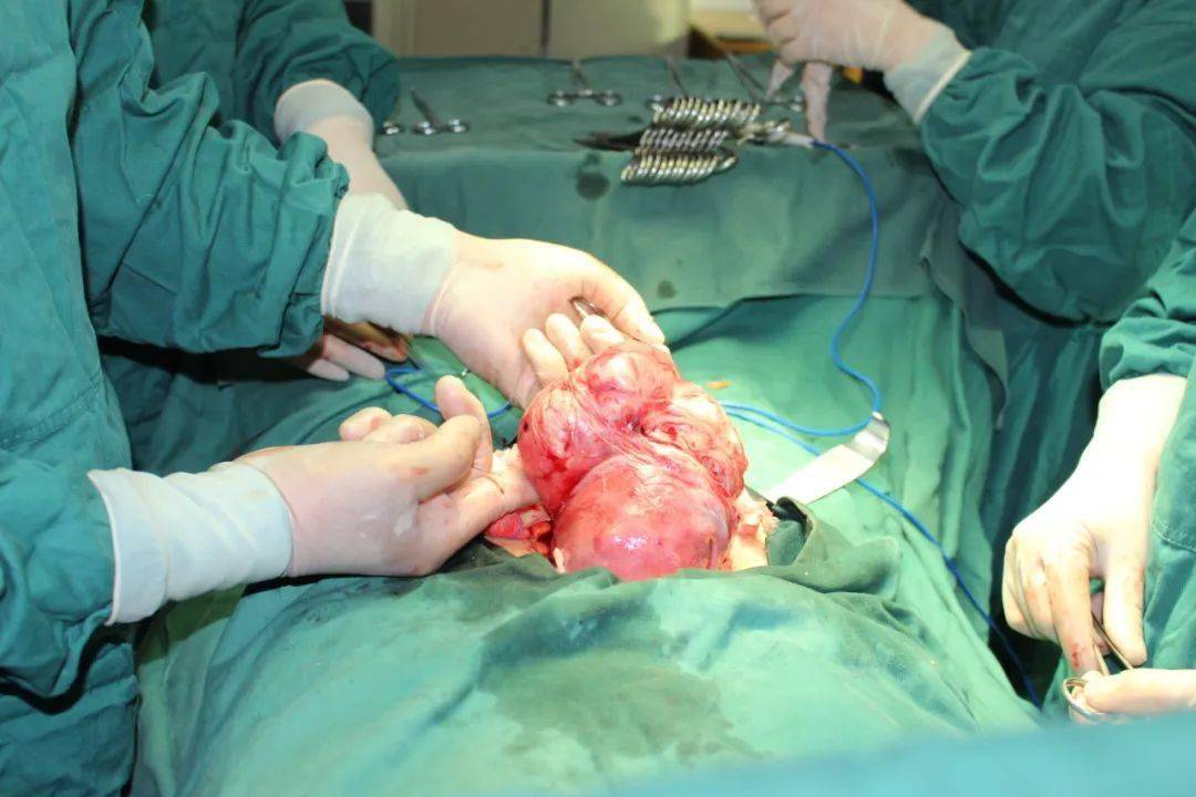 枣庄妇科大拿马学金院长为巨大子宫肌瘤患者成功手术