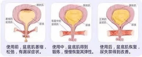 严重受损的盆底肌会带来一系列不良后果,例如盆腔器官脱垂,阴道壁膨出