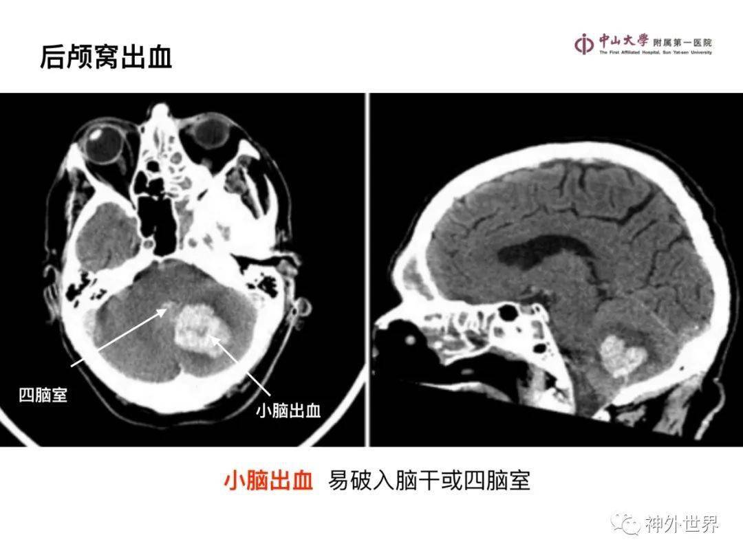 急诊头颅ct-"3b"阅片法,这个阅片法值得推荐