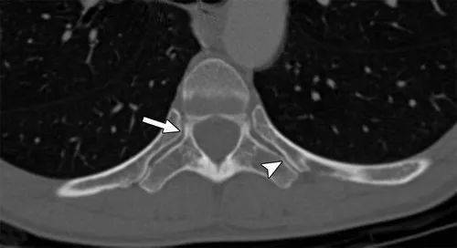 图3 - 正常年轻女性骨窗的右侧ct图像显示肋骨与椎骨关节连接,形成肋
