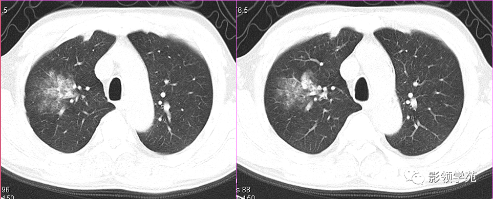 7种肺部基本病变影像表现 一,渗出实变和肺不张 二,增殖性病变 三