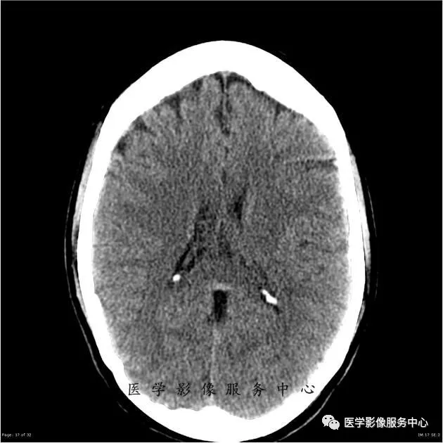 能在这例头颅ct上发现病变的,都是高手