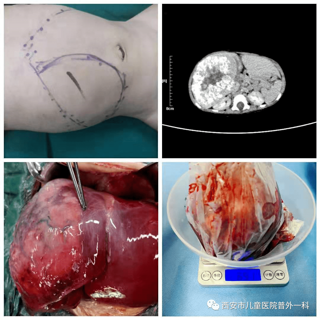 最大9岁,最小半岁,肝母细胞瘤,肝癌是咋找上小朋友的?