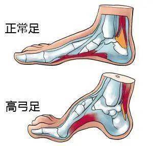 骨科医生提醒:给孩子买鞋千万避开这5大误区!