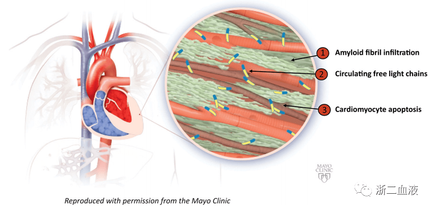 心肌淀粉样变的病理解读