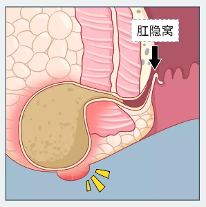 年轻男性最易中招_肛瘘