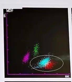 白细胞异常散点图背后的真相