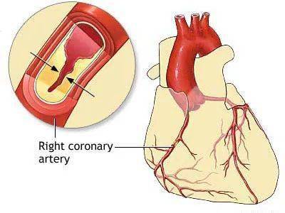 但是心脏本身也是需要供血供氧才能不停歇的干活,正是冠状动脉来完成