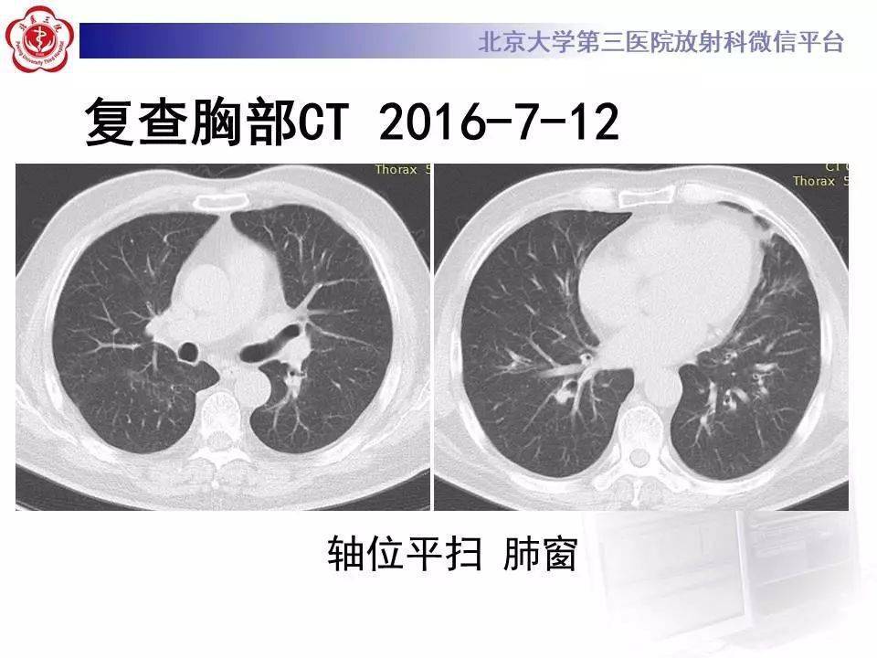 过敏性肺炎影像表现详细学习