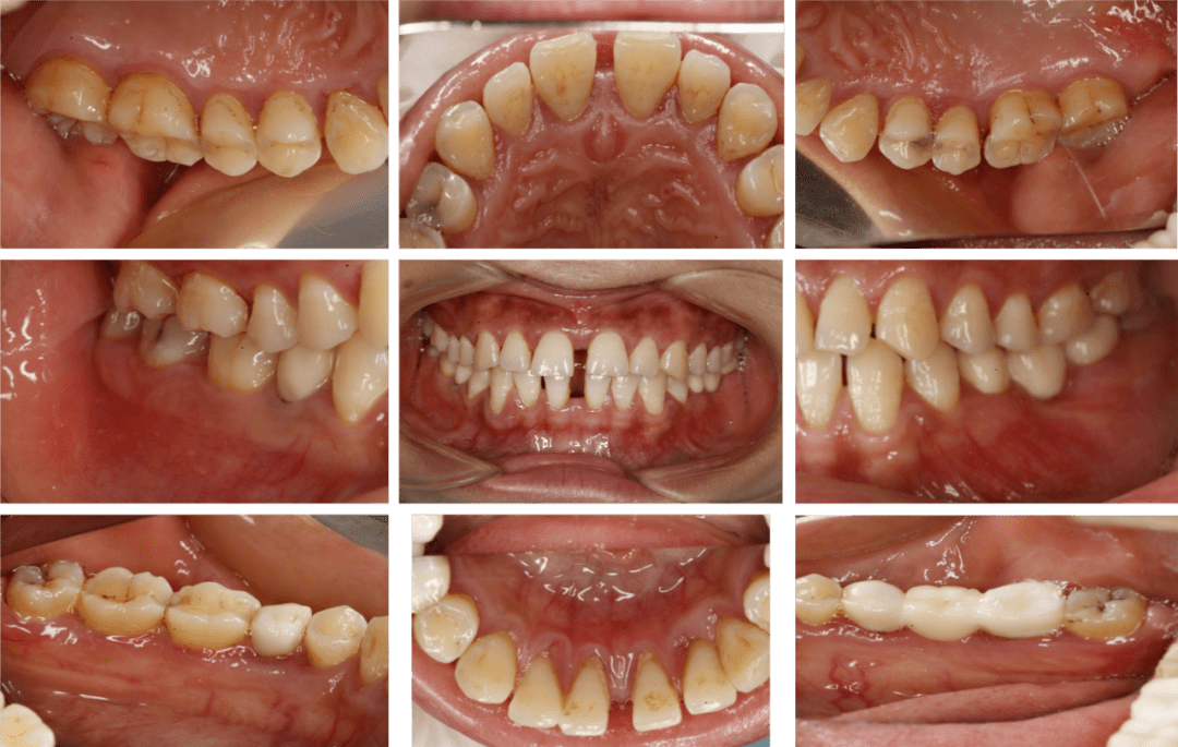 慢性牙周炎患者牙周序列治疗联合修复治疗1例