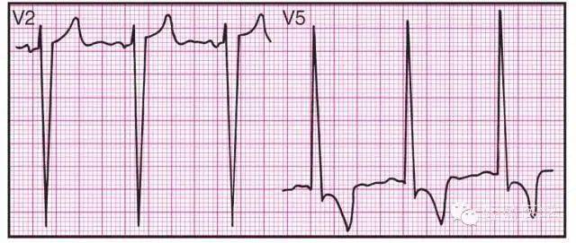 最全面的异常心电参考图建议收藏