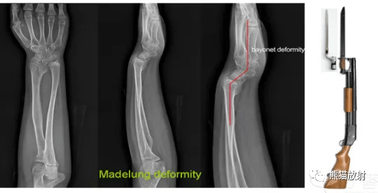 x线诊断要点丨骨与关节发育畸形(上肢)_桡骨