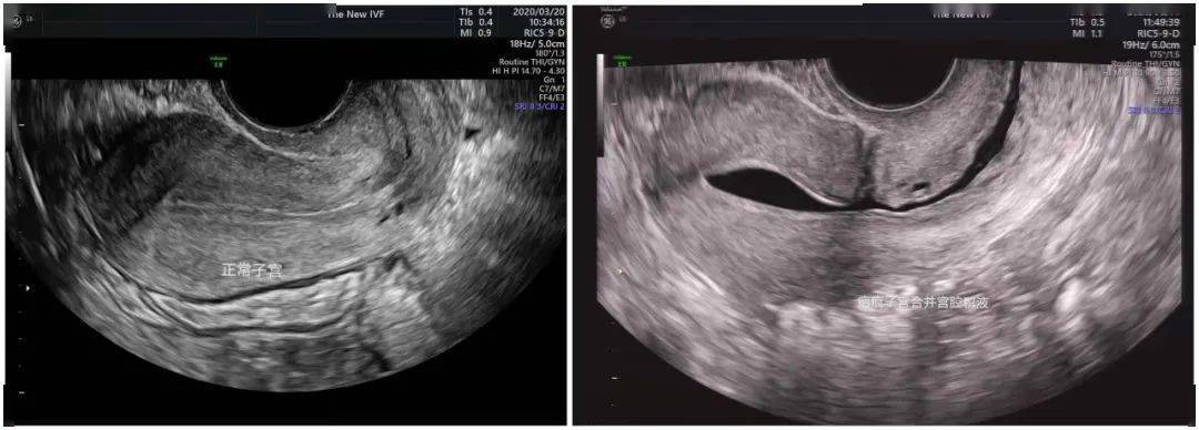 左图示:正常子宫;右图示:疤痕子宫合并宫腔积液