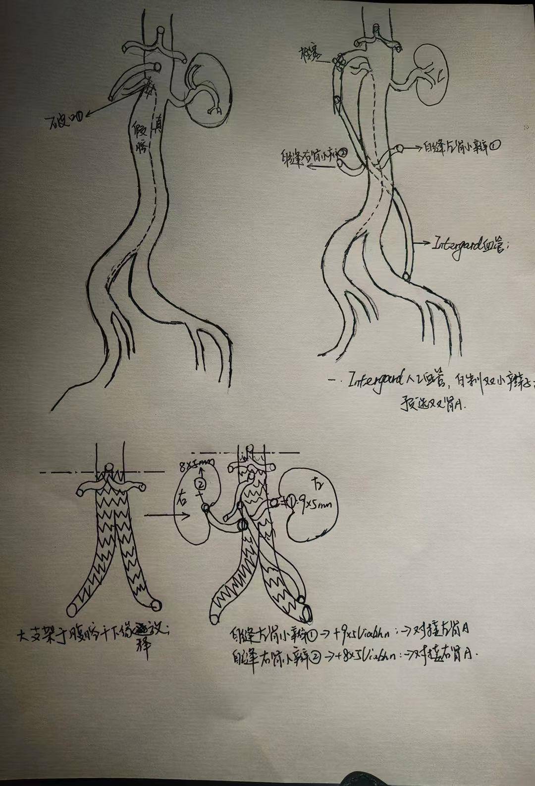 突发腹痛竟是严重腹主动脉夹层,市一医院为患者施行"一站式杂交手术"