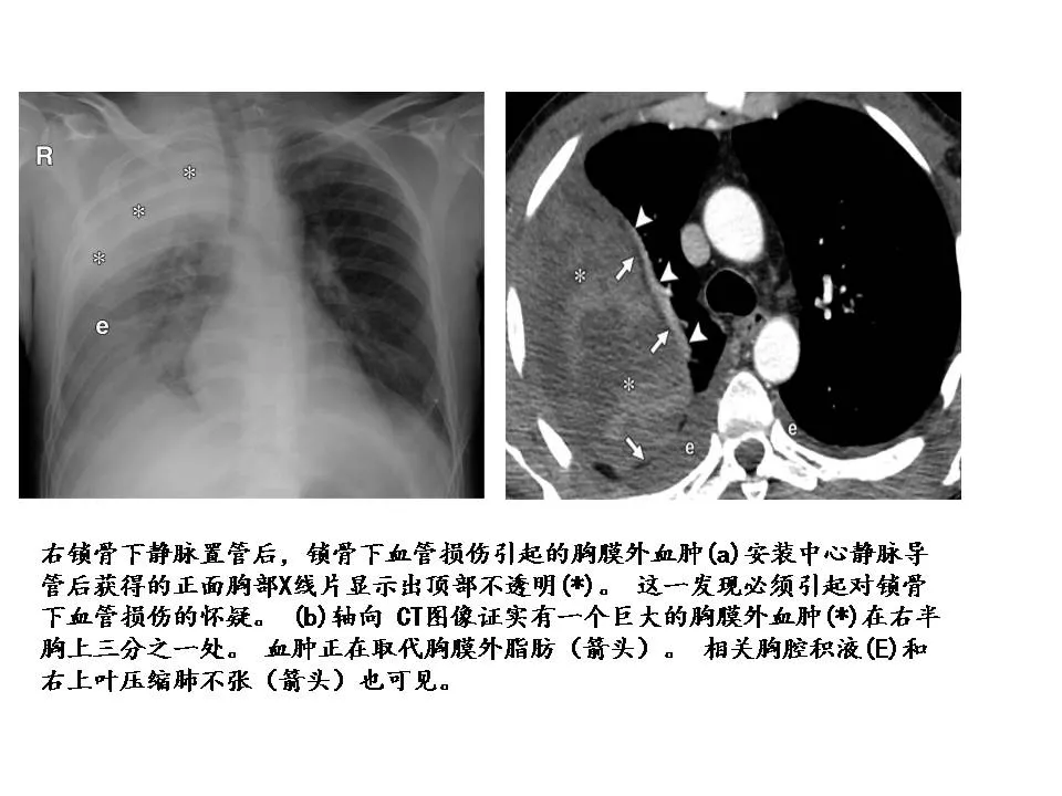 教你识别胸膜外间隙ct表现