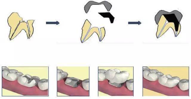 传统桩核冠方式修复后牙牙体缺损示意图