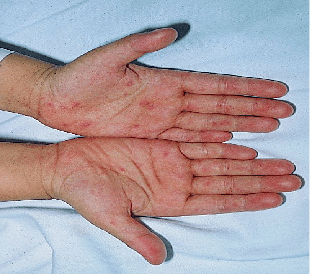 一,不同点:疱疹性咽峡炎仅在口腔有疹;手足口病的皮疹可在手掌,足底