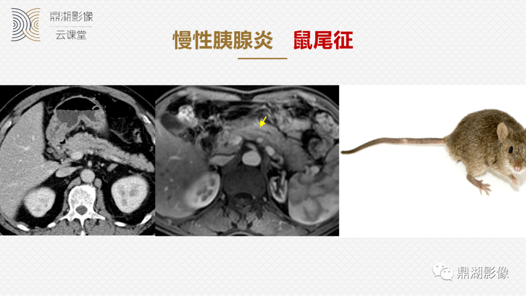 征:淋巴瘤胰管穿行征:局灶性胰腺炎;较早期胰腺癌(少见)胰管鼠尾征