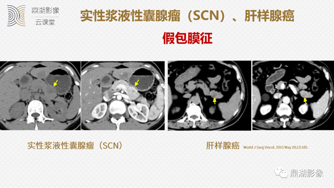 速记!十五大影像特征与胰腺病变