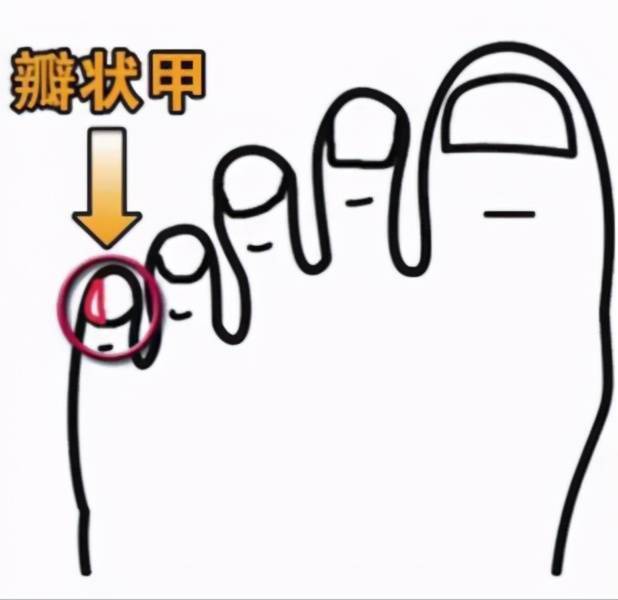 小脚趾指甲长成两瓣,才是"纯血"的汉族人,这个说法靠谱吗?_研究
