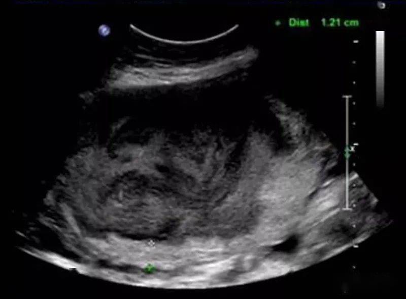 膜状胎盘:胎盘增厚,其内可见大片无回声,且胎盘实质回声较少,实质