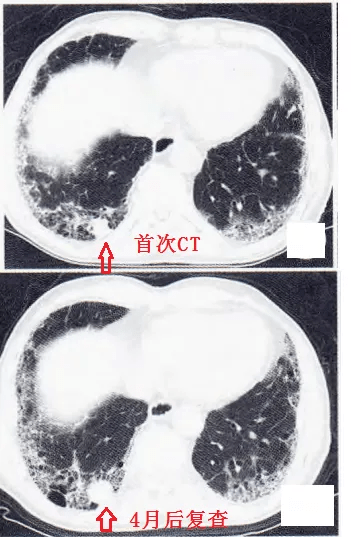 这份「肺纤维化 肺癌」读片秘籍,请收好