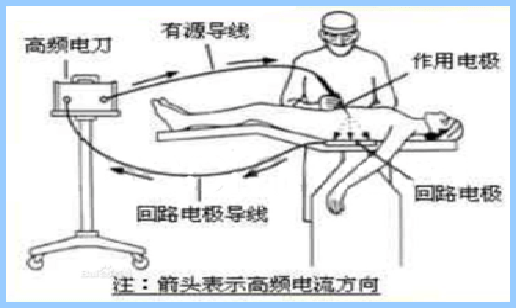 二,高频电刀安全使用注意事项