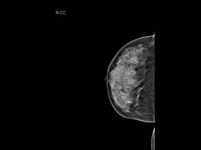 乳腺超声和x线检查都有毛刺的表述但二者完全对应吗