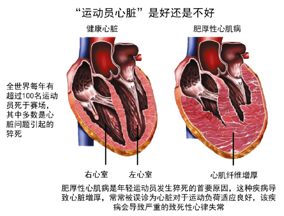 普通大众跑者健身性质的跑步不太可能像运动员那样发生"运动员心脏"