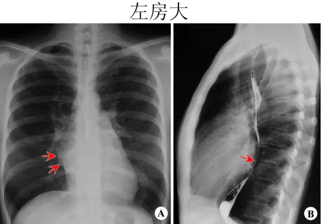 x线中的心影增大你真的会看吗